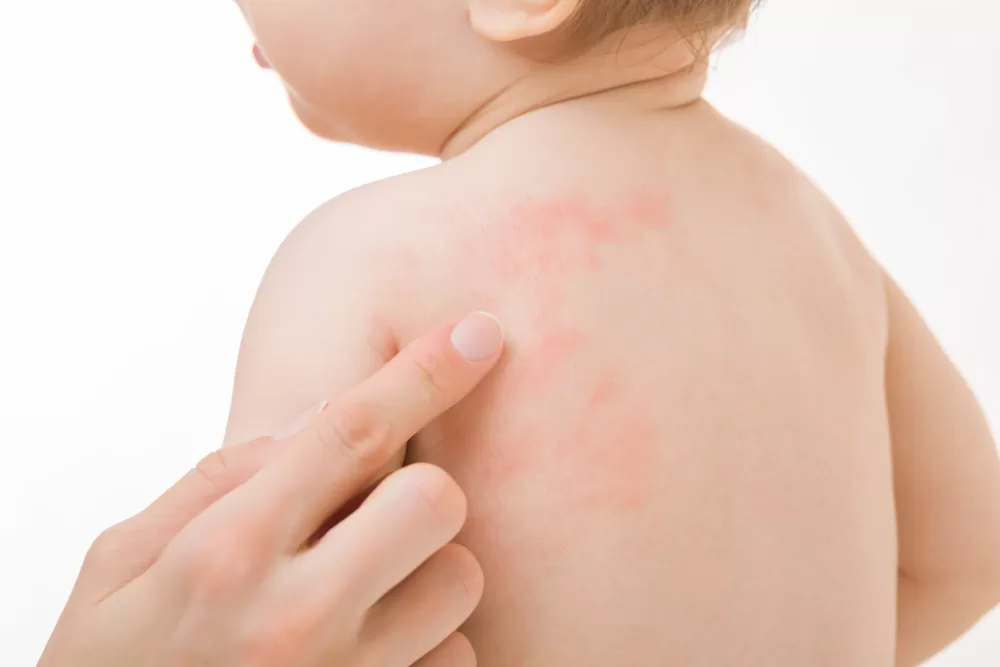 ¿Qué hacer si tu bebé tiene alergias en la piel?